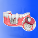 FULL MOUTH DENTAL IMPLANT